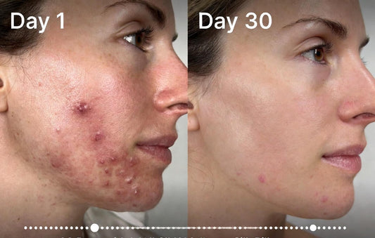 Before and after photos showing acne improvement after 30 days using mulberry silk pillowcase
